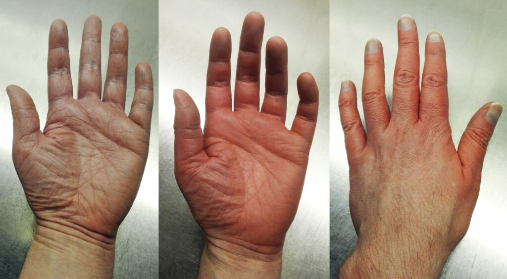 Long-Term Sensations and Recovery